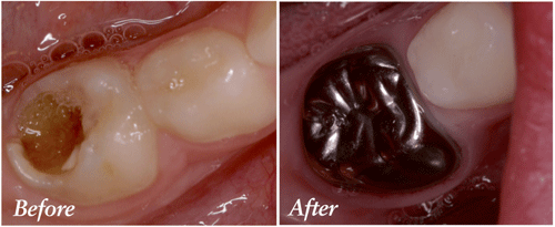 What is a "Baby Root Canal and Stainless Steel Crown?