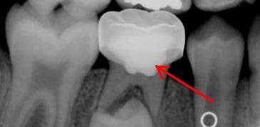 What is a "Baby Root Canal and Stainless Steel Crown?