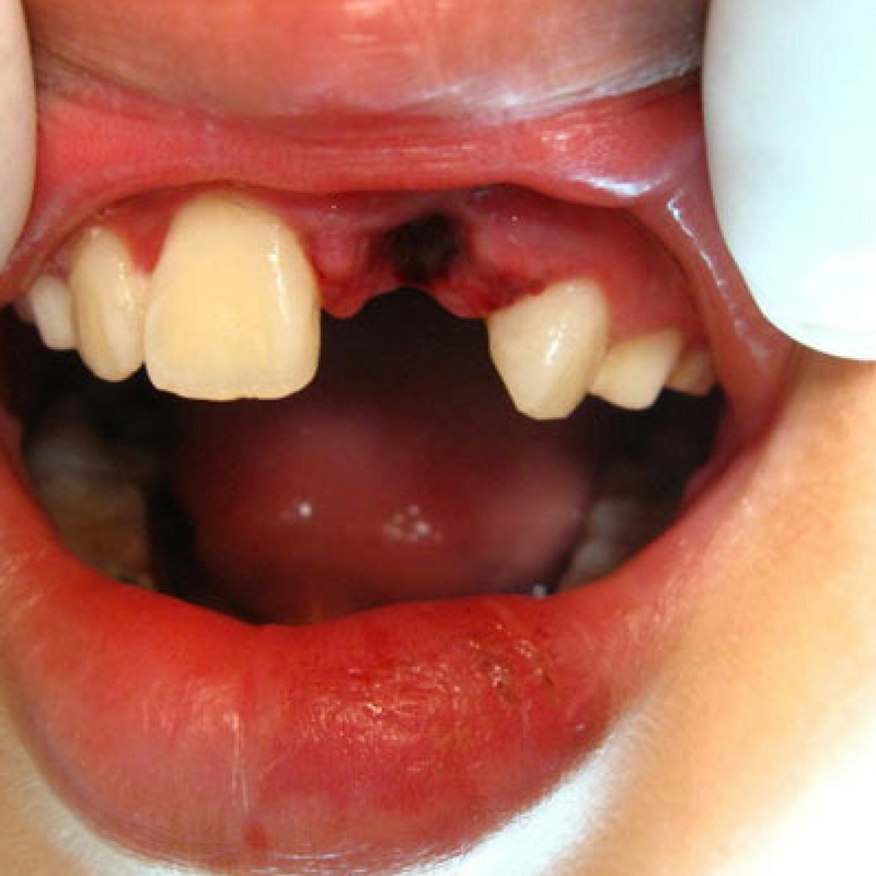 save a knocked out tooth